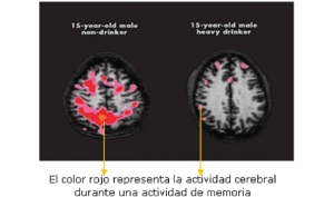 Daños del alcohol al cerebro Cuáles son